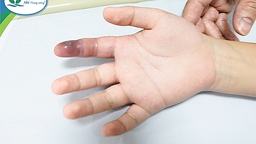 Lén nuôi rắn làm thú cưng, bé trai 13 tuổi bị cắn nguy hiểm tới tính mạng