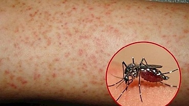 Dengue fever cases rise, 22 deaths recorded