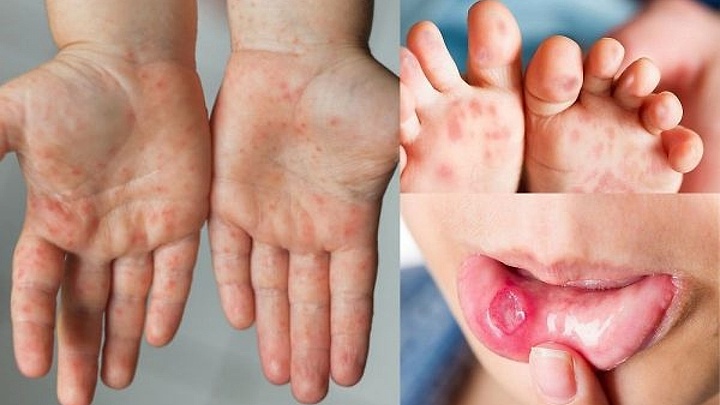 Hanoi sees fivefold jump in hand-foot-mouth disease cases 