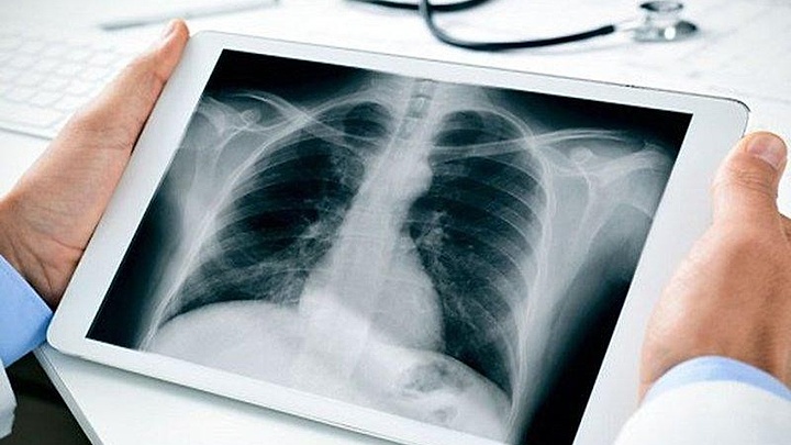 26,000 new lung cancer patients diagnosed in Vietnam annually 